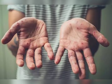 monkeypox-4-16533673523x2