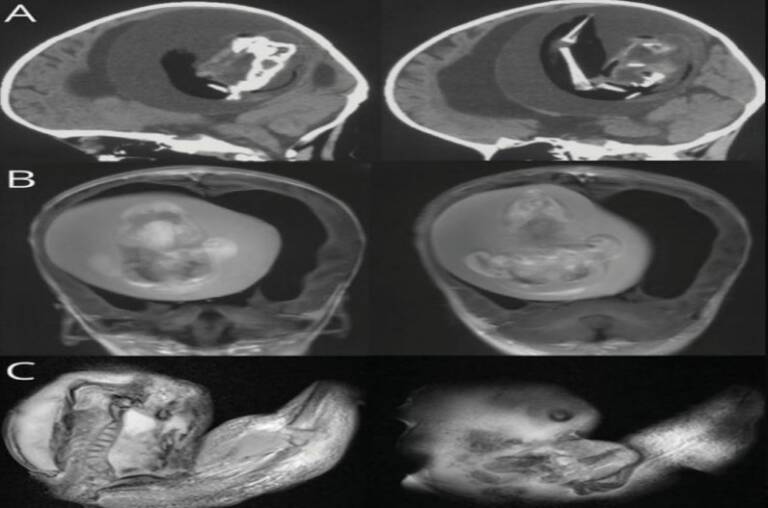 Fetus-was-growing-in-the-childs-brain