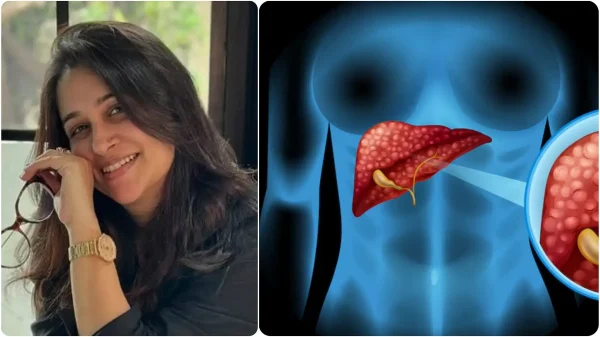 dipika-kakar-liver-tumor_8b64a17b5d659261d0224b003bbf6e80-r6gk25ufm9xhzkvbgbknv80u63vexkupfa8kukk20a