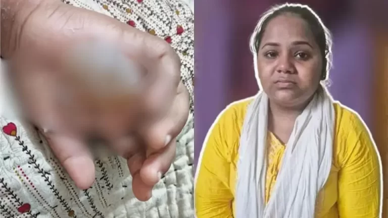 teacher-burns-student-hand-363630105